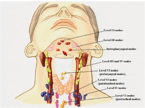 cervical lymph node cancer
